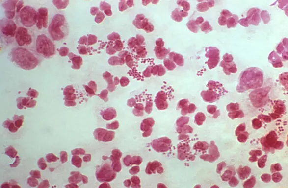 Non-Gonococcal Urethritis (NGU) Singapore | Testing, Symptoms & Treatment