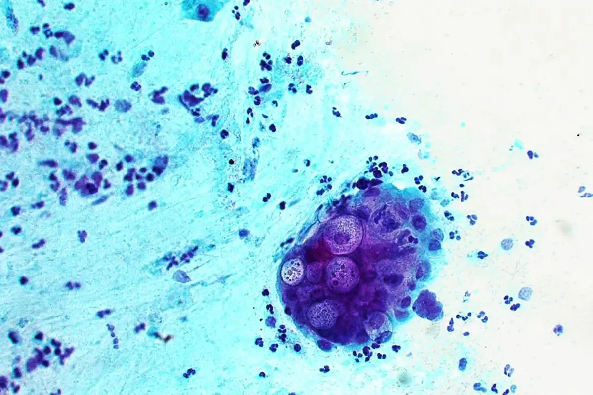 Lymphogranuloma Venereum (LGV) vs. Chlamydia - What You Need To Know